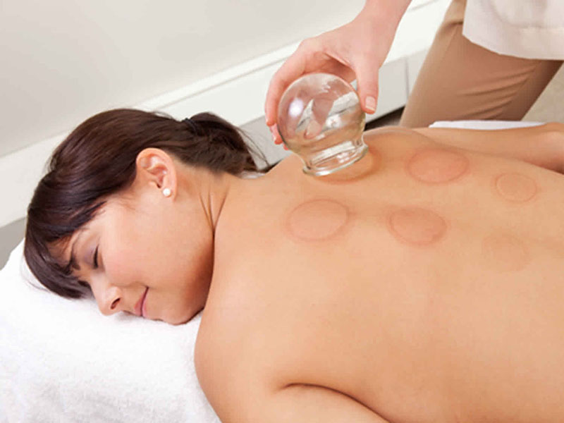 cupping therapynew